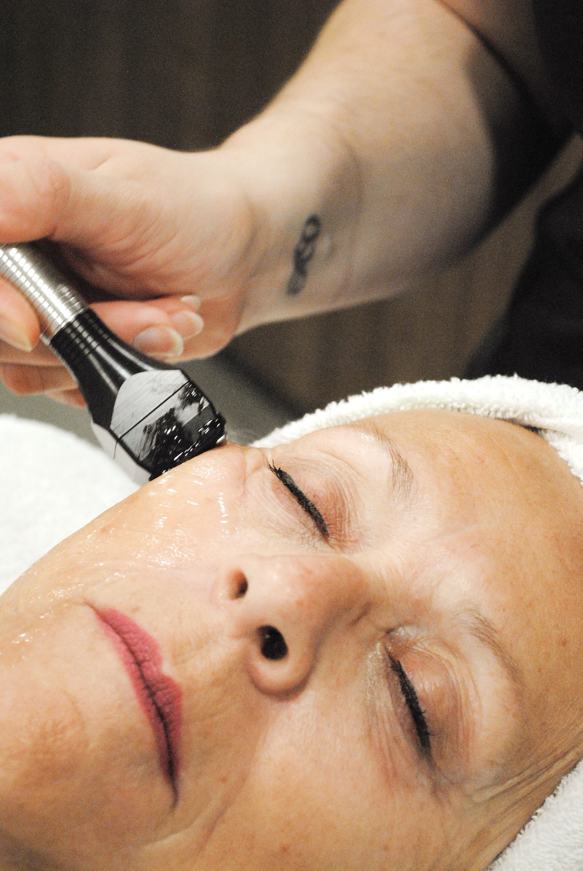 Forma radiofrequency treatment at Focus Aesthetics