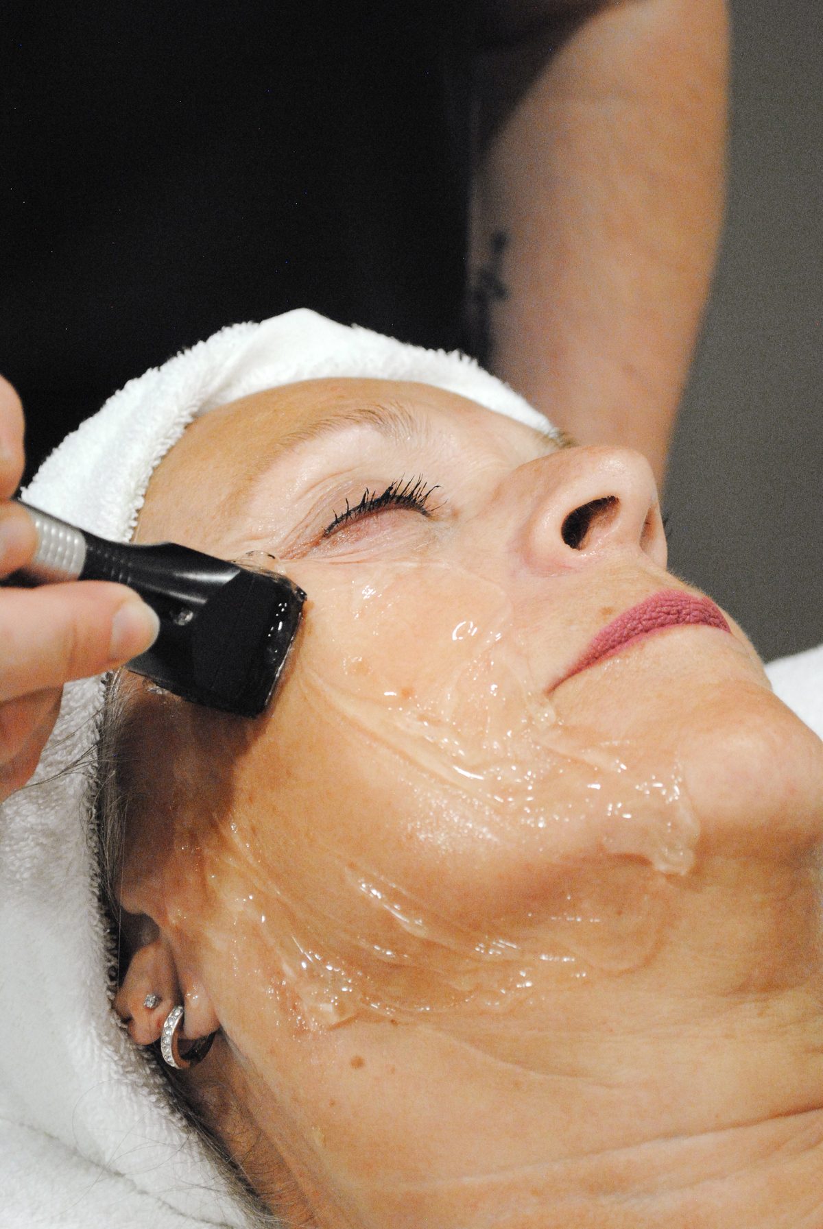 Lumecca IPL treatment at Focus Aesthetics